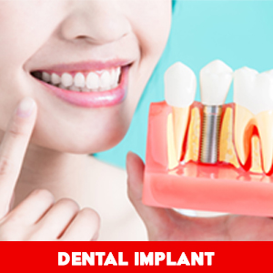 dental implants california