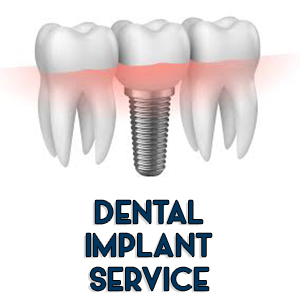 Dental Implant Service | SMile Select Dental