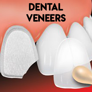 Dental Veneers | Smile Select Dental