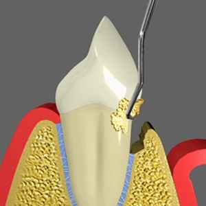 Scaling Periodontal Care