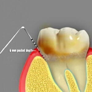 dental prophylaxis